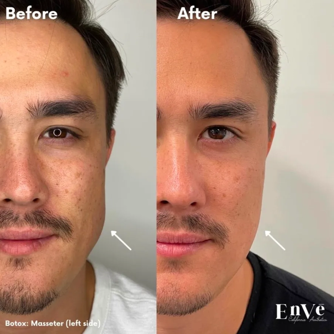 Botox Before and After at Enve California Aesthetics