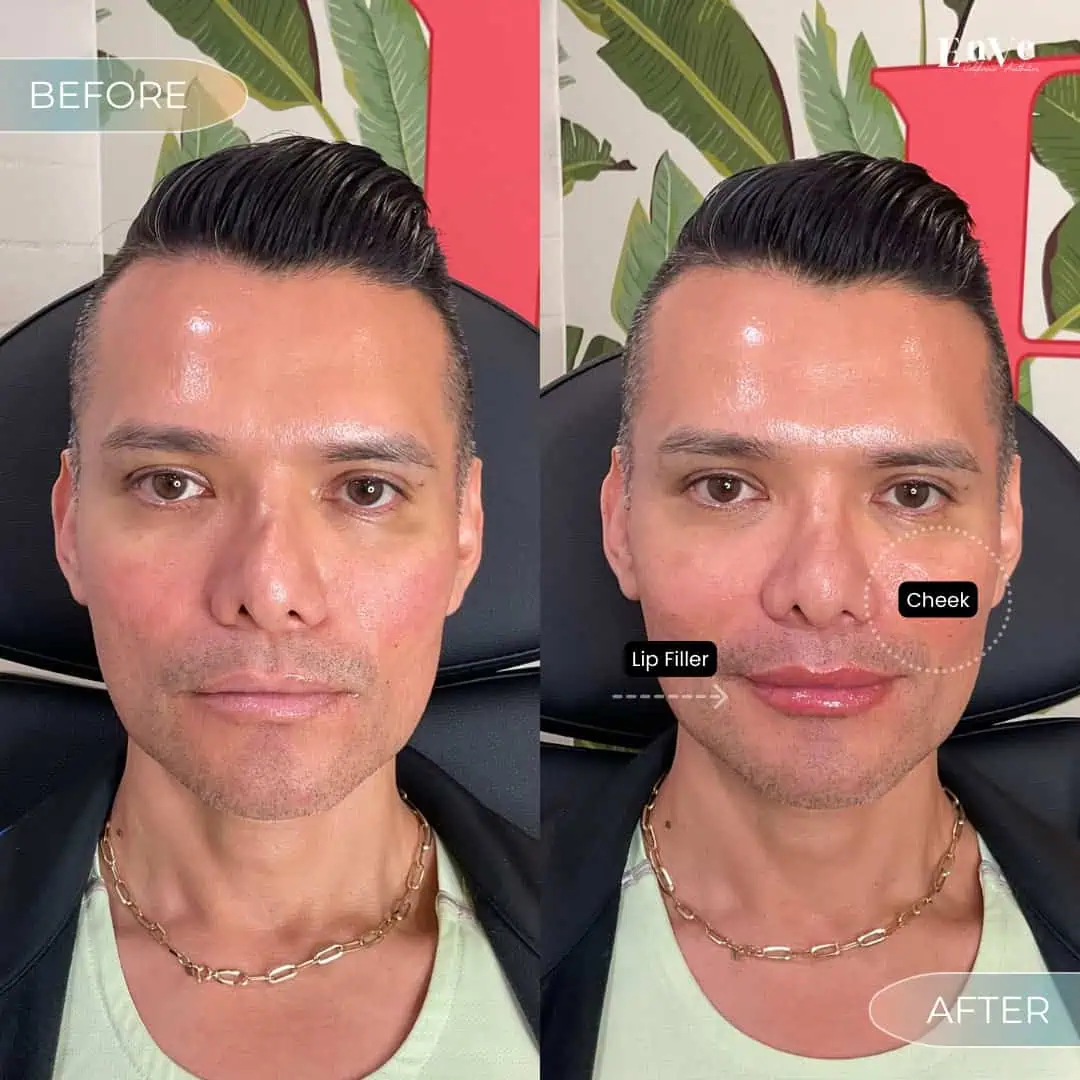 Chin Filler Before and After at Enve California Aestheticsac