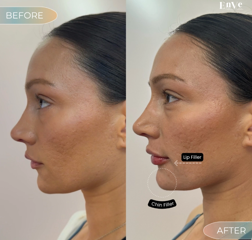 Chin Filler Before and After at Enve California Aesthetics