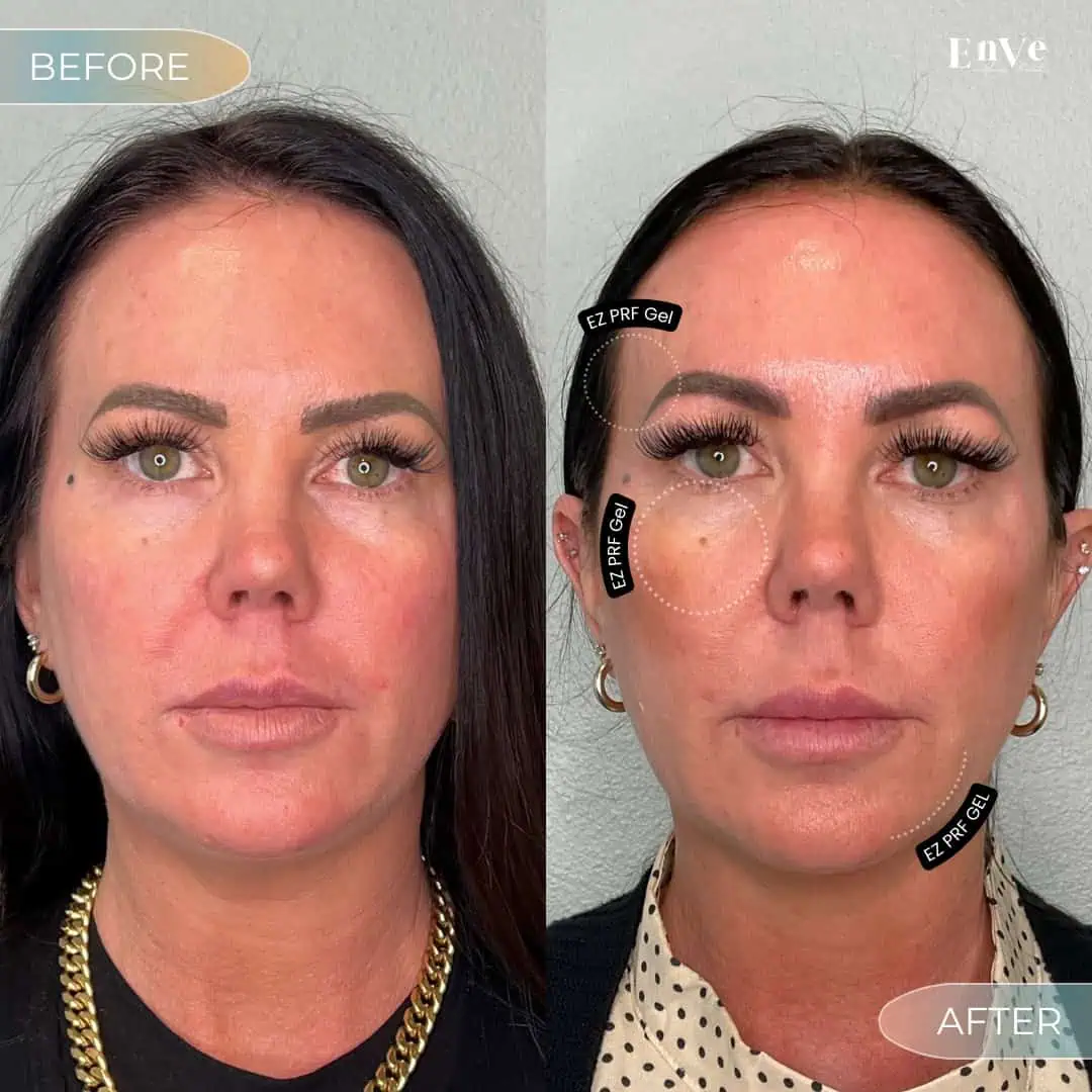 EZ PRF GEL Before and After1 at Enve California Aesthetics
