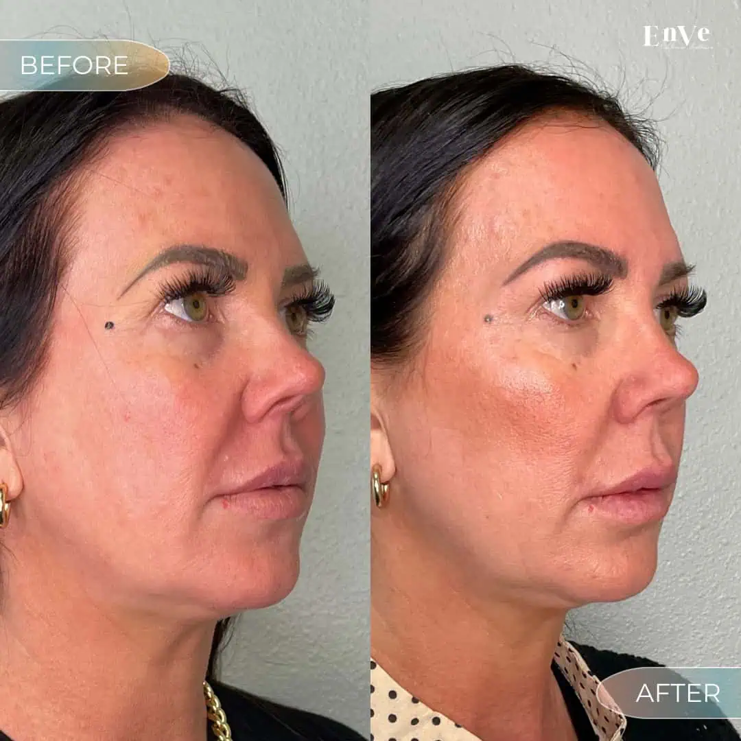 EZ PRF GEL Before and After at Enve California Aesthetics