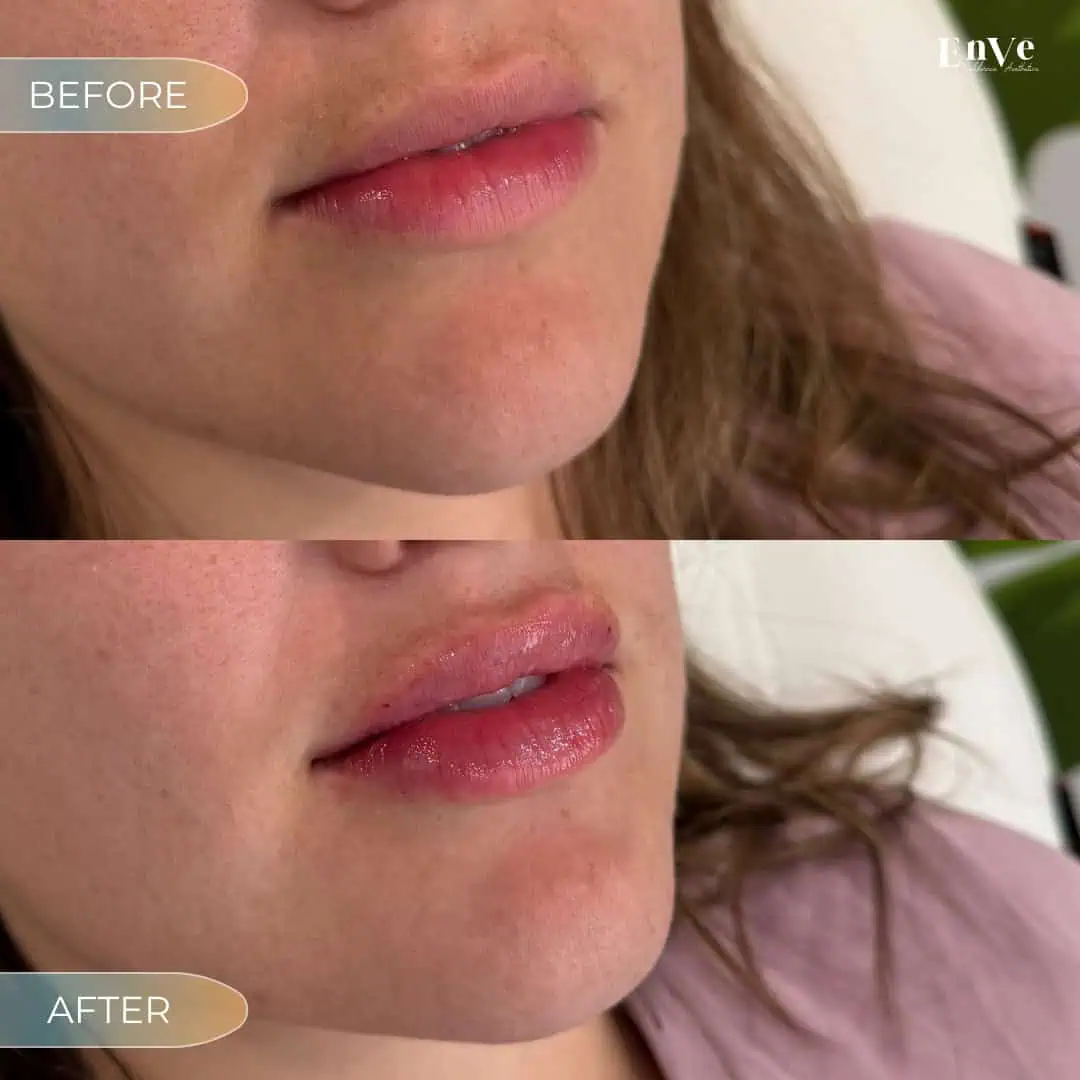 Lip Filler Before and After4 at Enve California Aesthetics