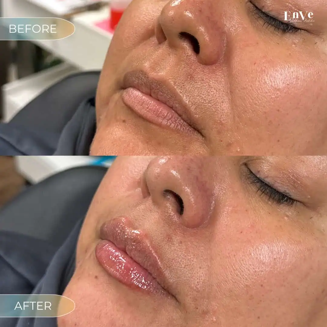 Lip Filler Before and After3 at Enve California Aesthetics