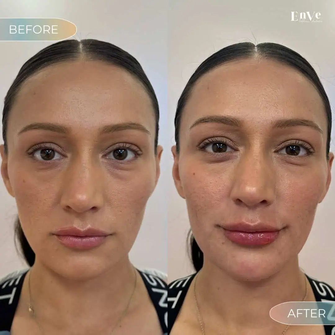 Lip Filler Before and After2 at Enve California Aesthetics