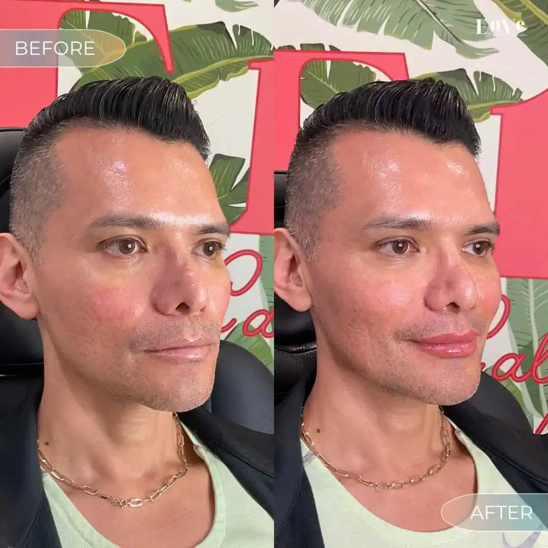 Lip Filler Before and After1 at Enve California Aesthetics