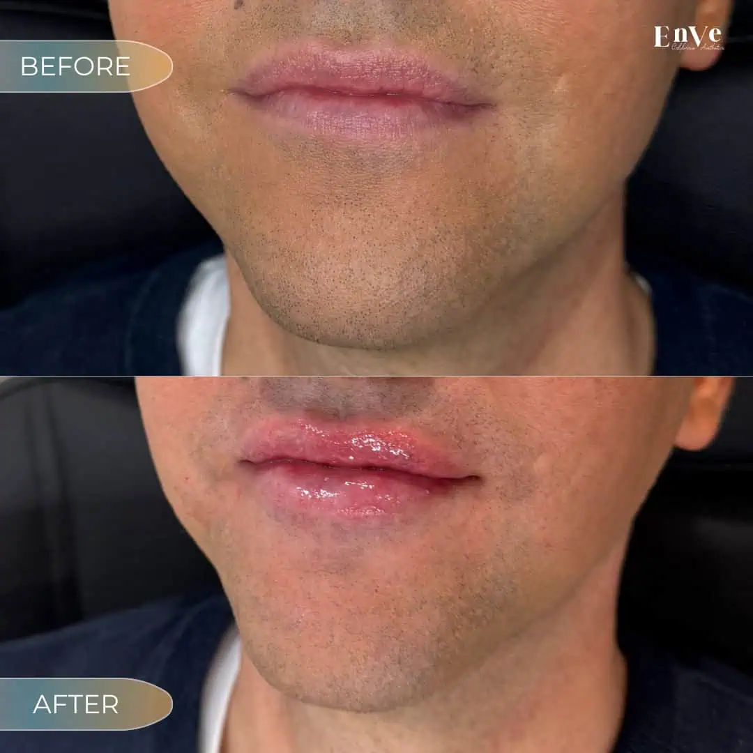 Lip Filler Before and After at Enve California Aesthetics