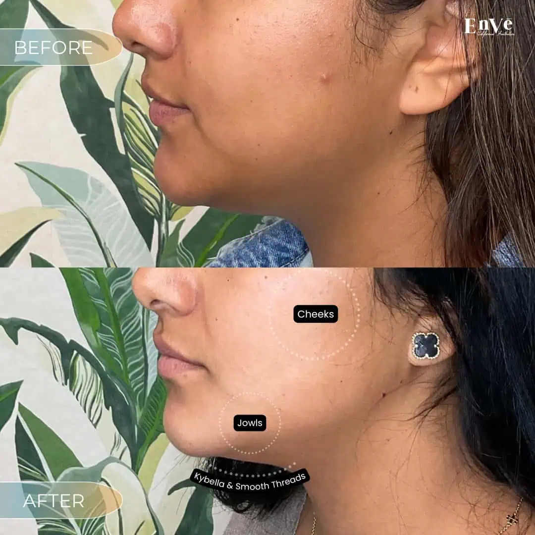 Filler Before and After2 at Enve California Aesthetics