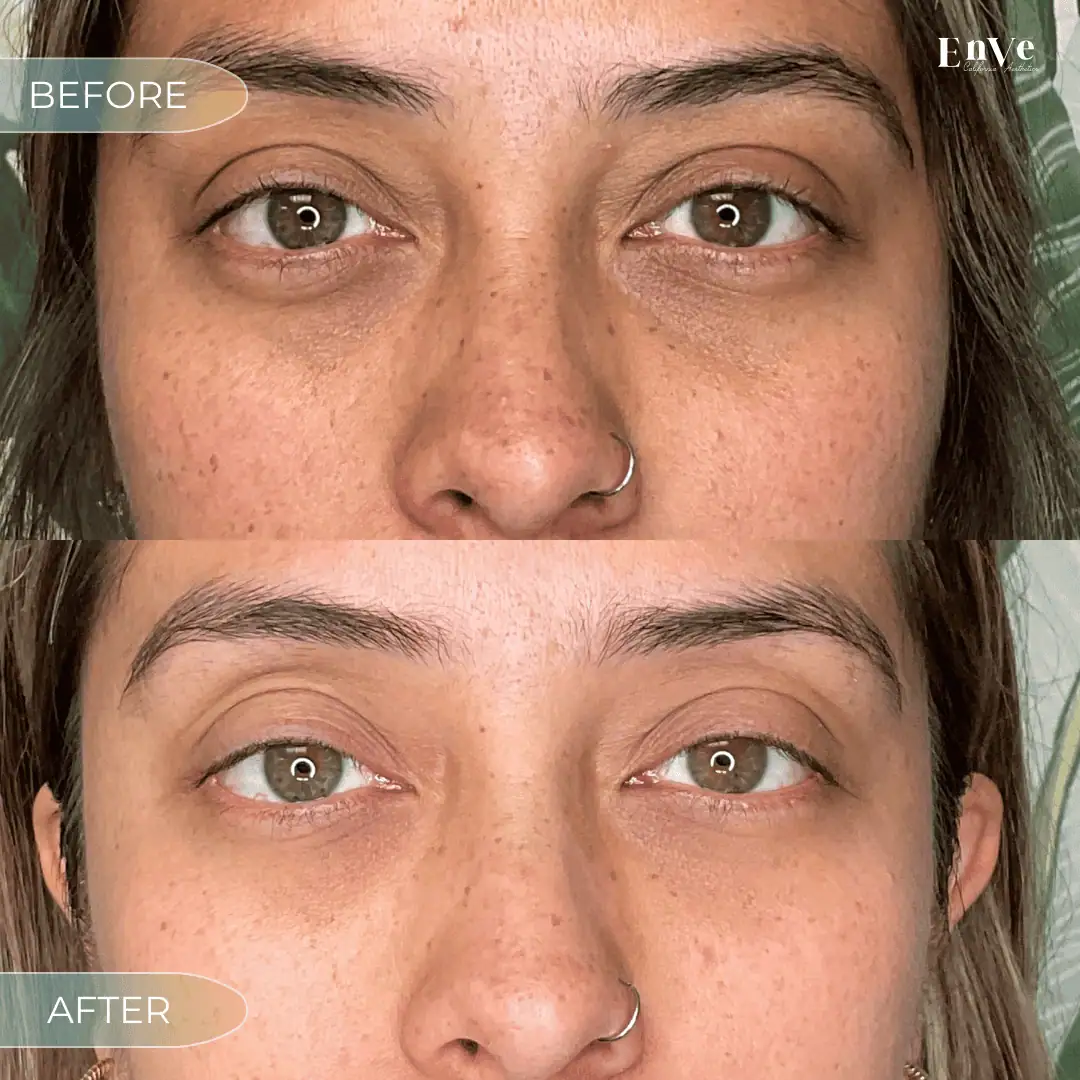 PRP Under Eye Before and After at Enve California Aesthetics