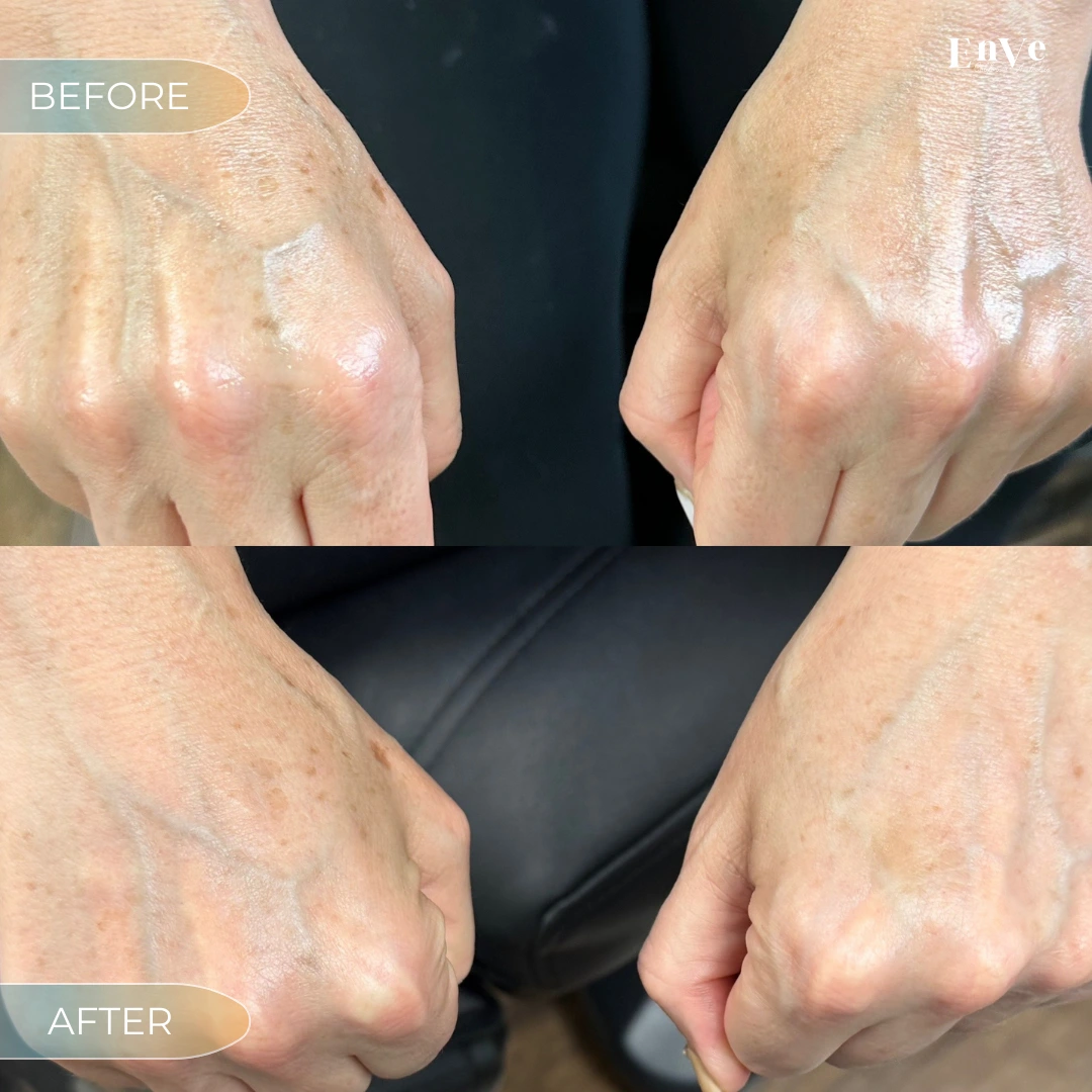 Hand rejuvenation treatment with Sculptra to restore volume and reduce wrinkles