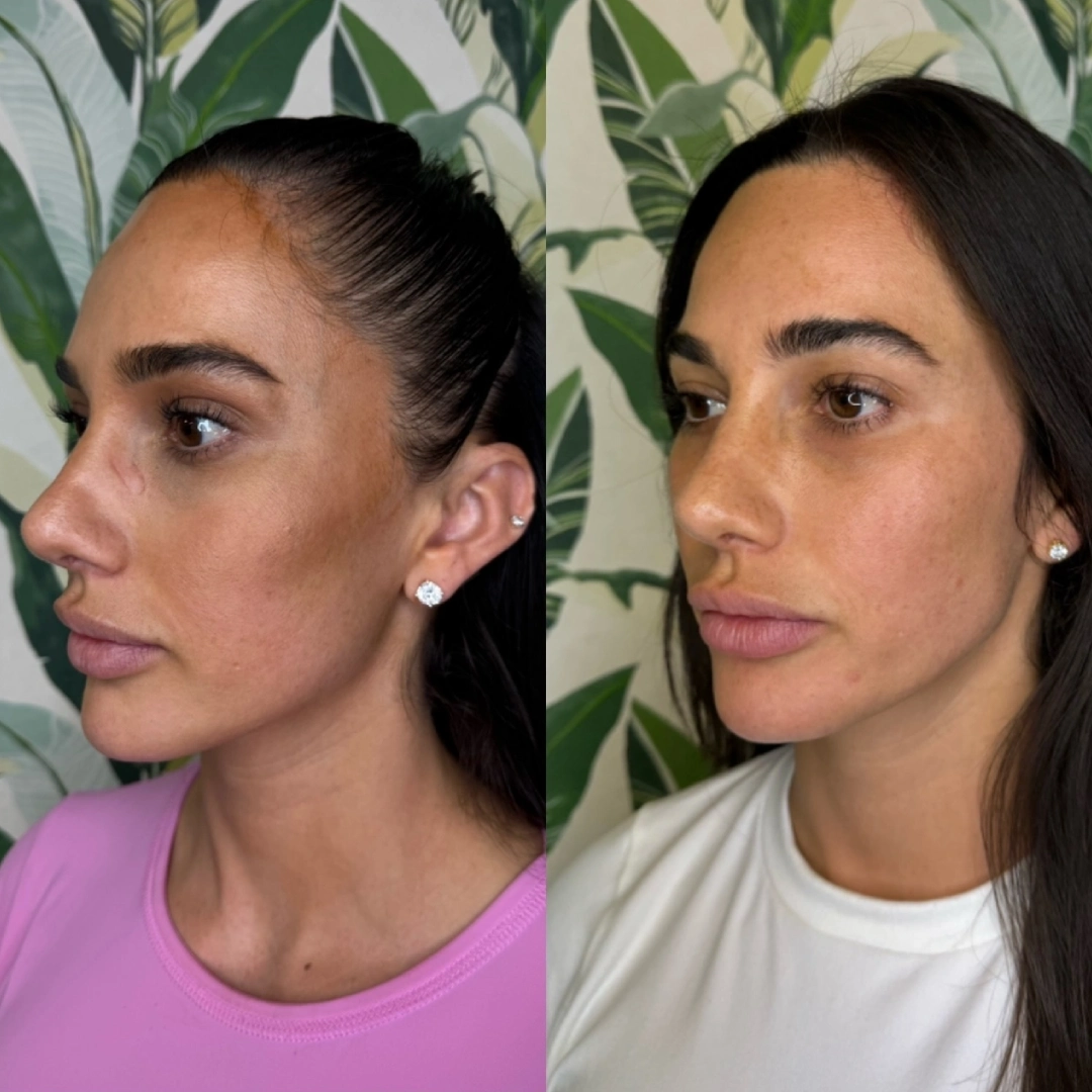 Sculptra before and after results showing enhanced facial volume and skin rejuvenation at Enve California Aesthetics