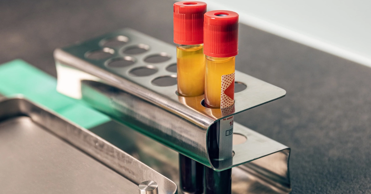 Two blood tubes with separated plasma and red cells in a metal holder on a clinical tray for PRF vs PRP in Poway, San Diego.