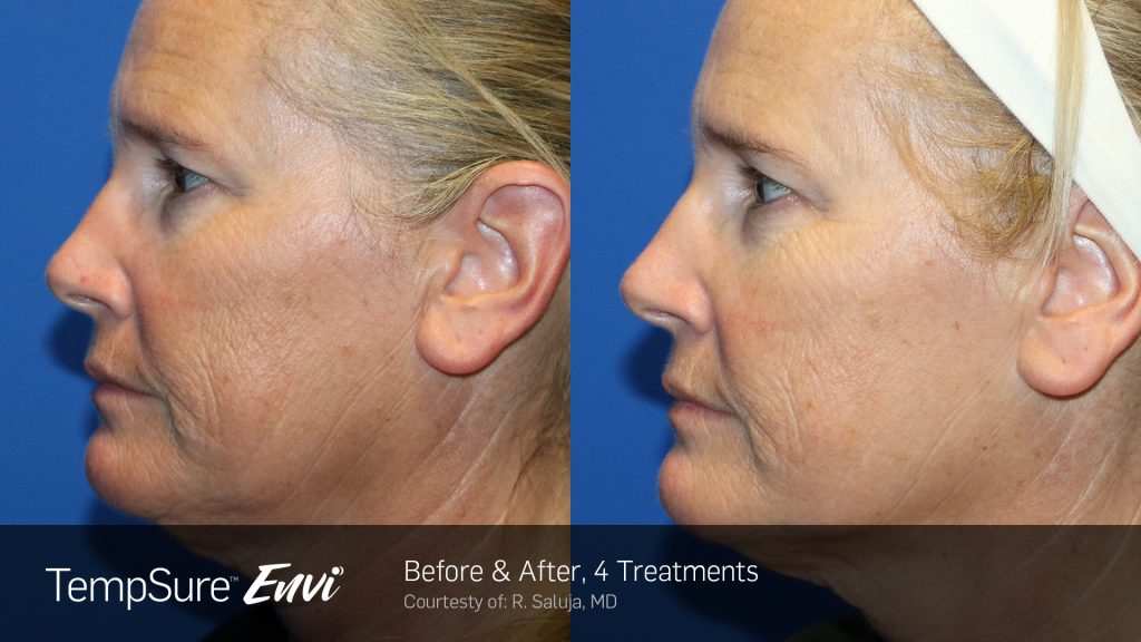 Before and after TempSure Envi treatments