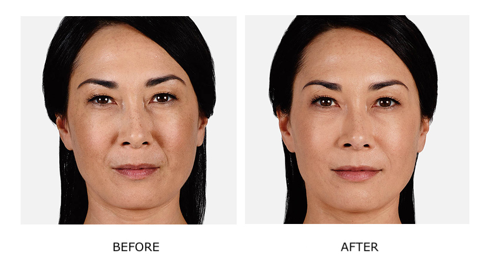 Before and after results for Ultra Plus