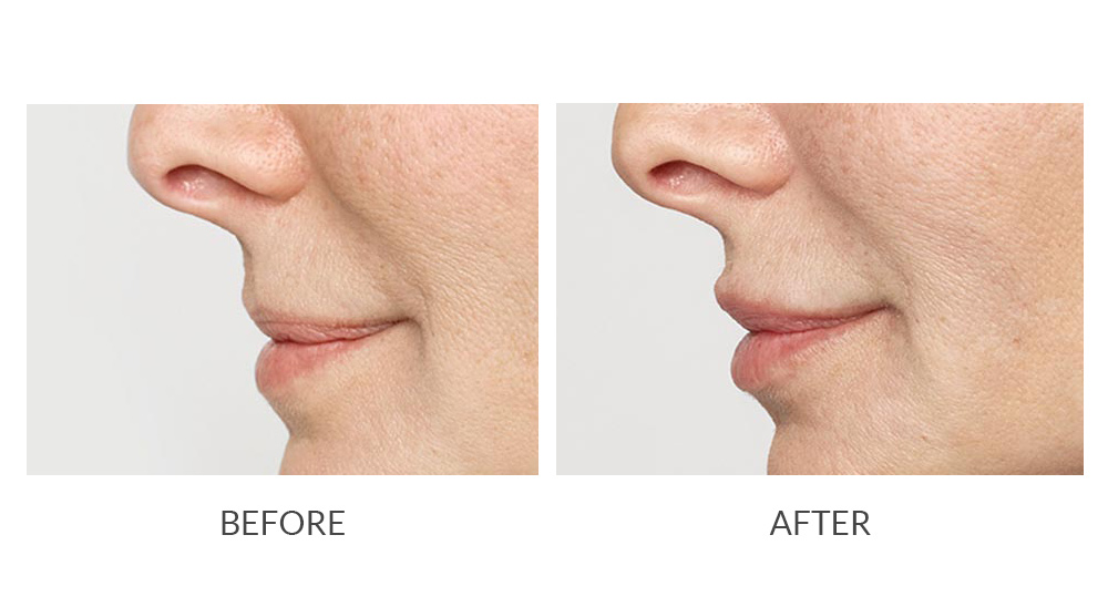 Before and after Restylane lip photos