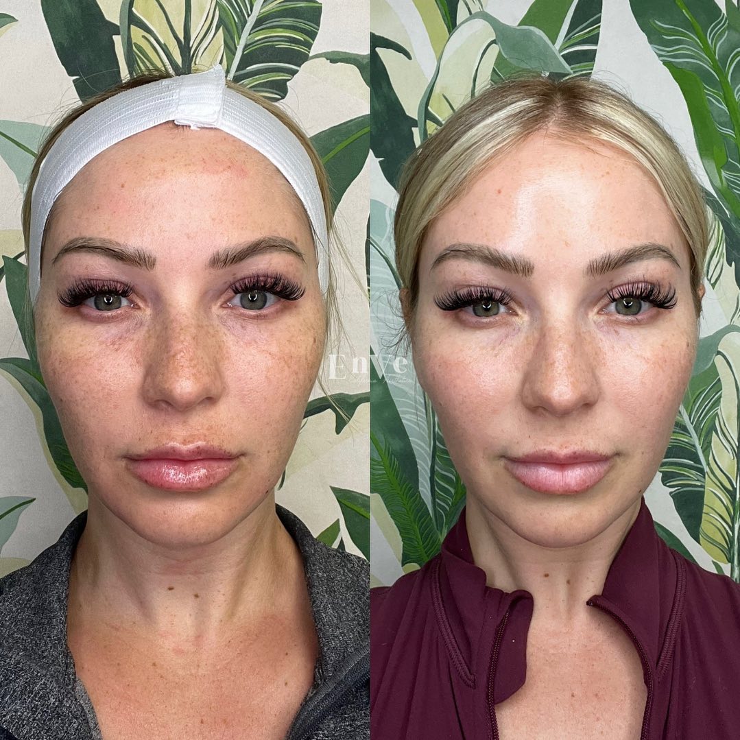 MICRONEEDLING + EXOSOMES RESULTS