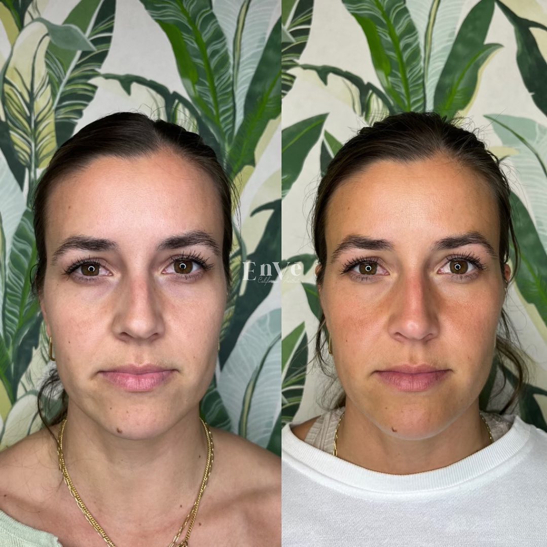 Natural Sculptra results with just 2 sessions!