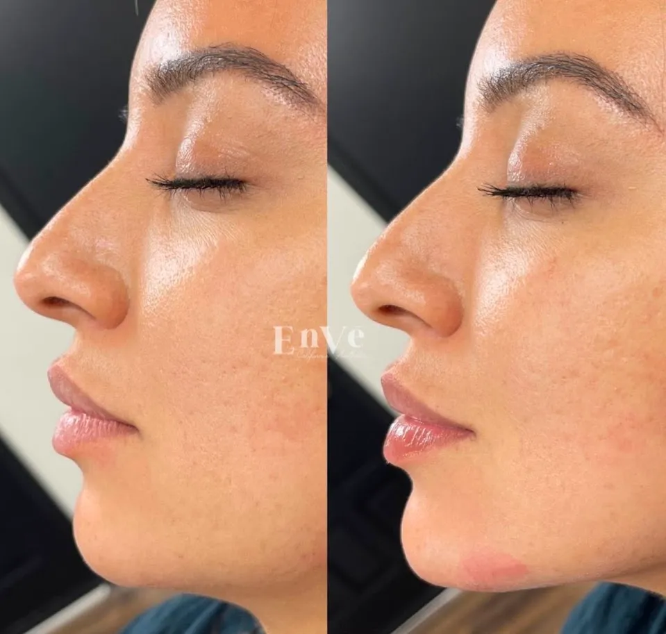 Kybella Before and After1 at Enve California Aesthetics