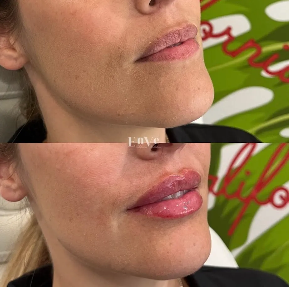 Lip Filler Before and After5 at Enve California Aesthetics