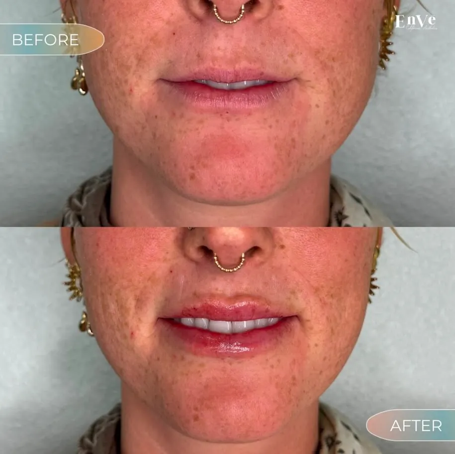 Lip Filler Before and After4 at Enve California Aesthetics