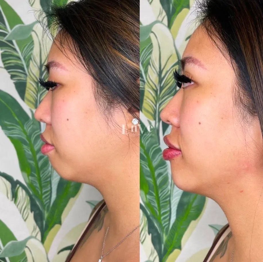 Kybella Before and After at Enve California Aesthetics