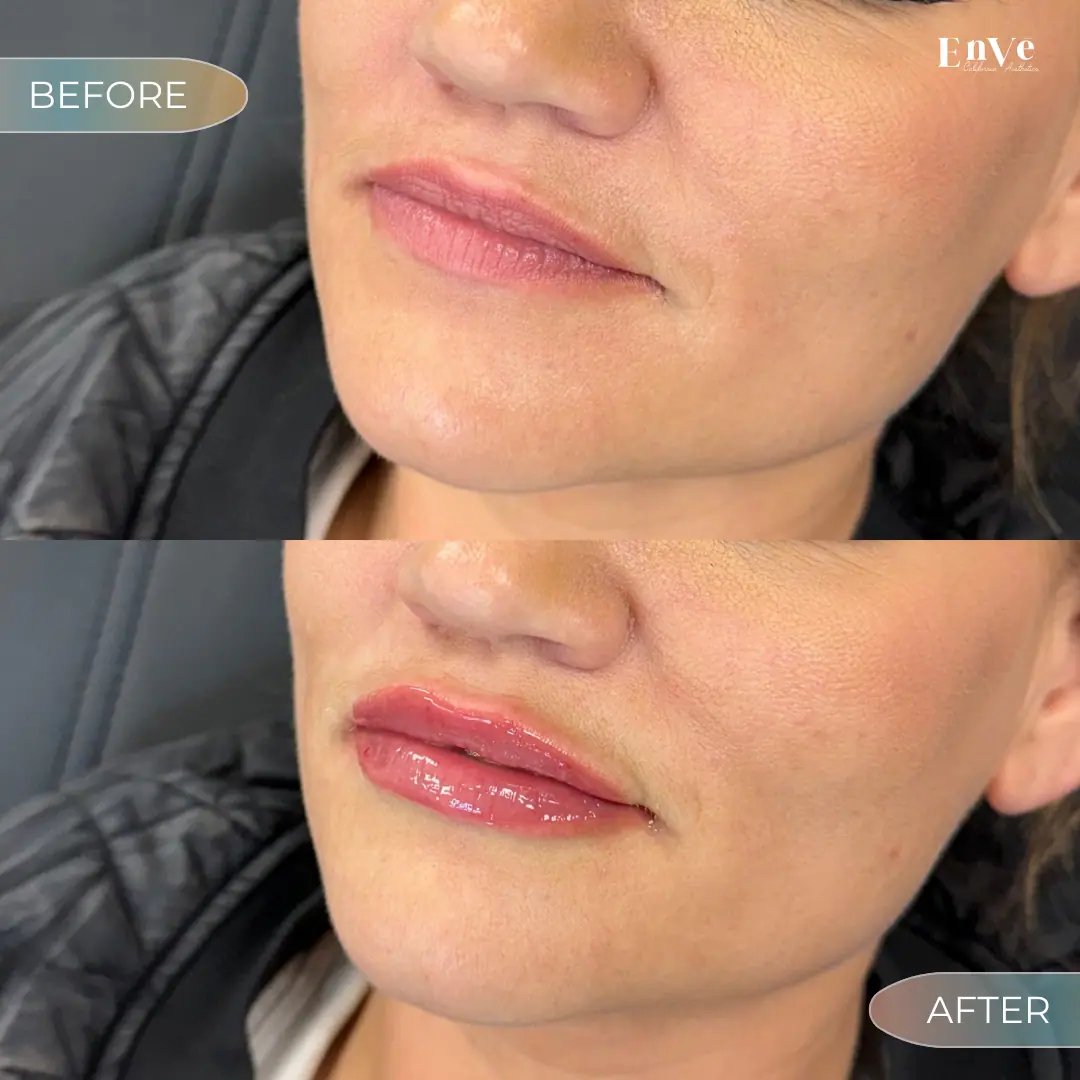 Lip Filler Before and After 11 At Enve California Aesthetics