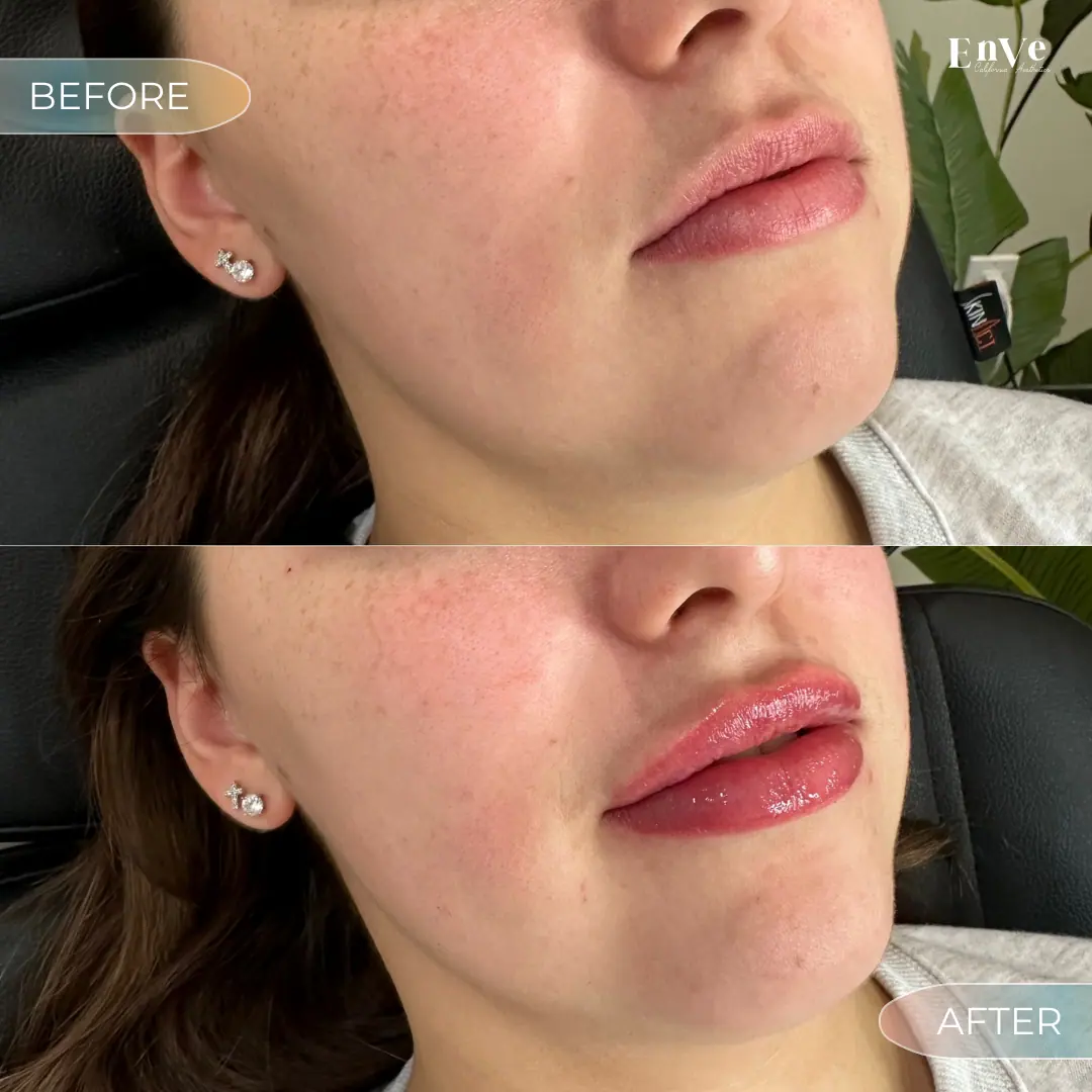 Lip Filler Before and After 12 At Enve California Aesthetics