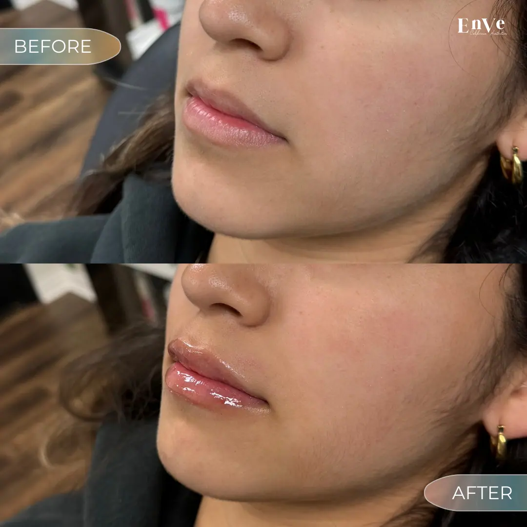 Lip Filler Before and After 13 At Enve California Aesthetics