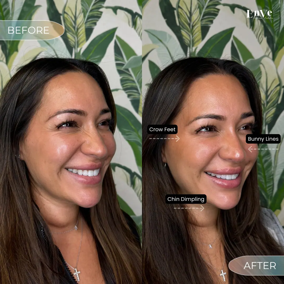 woman's face before and after Botox treatment, showing significant reduction in forehead lines and smoother skin in the after image.