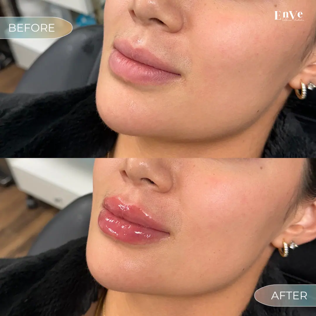 Lip Filler Before and After 14 At Enve California Aesthetics