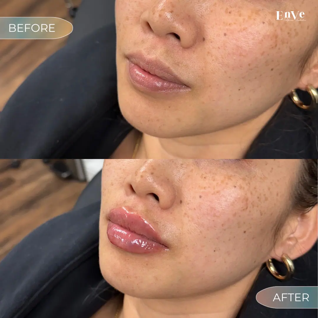 Lip Filler Before and After 15 At Enve California Aesthetics