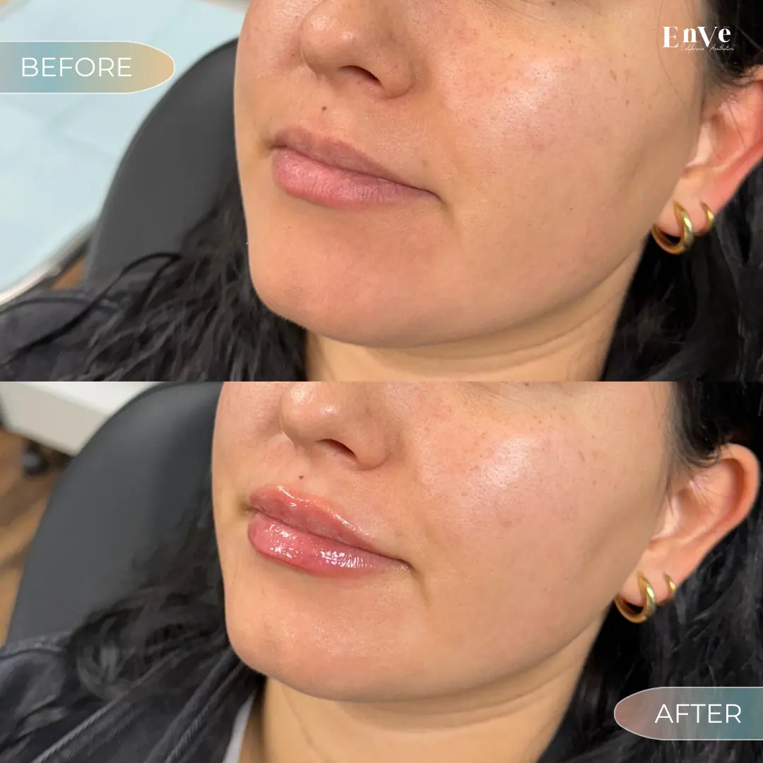 Lip Filler Before and After 16 At Enve California Aesthetics