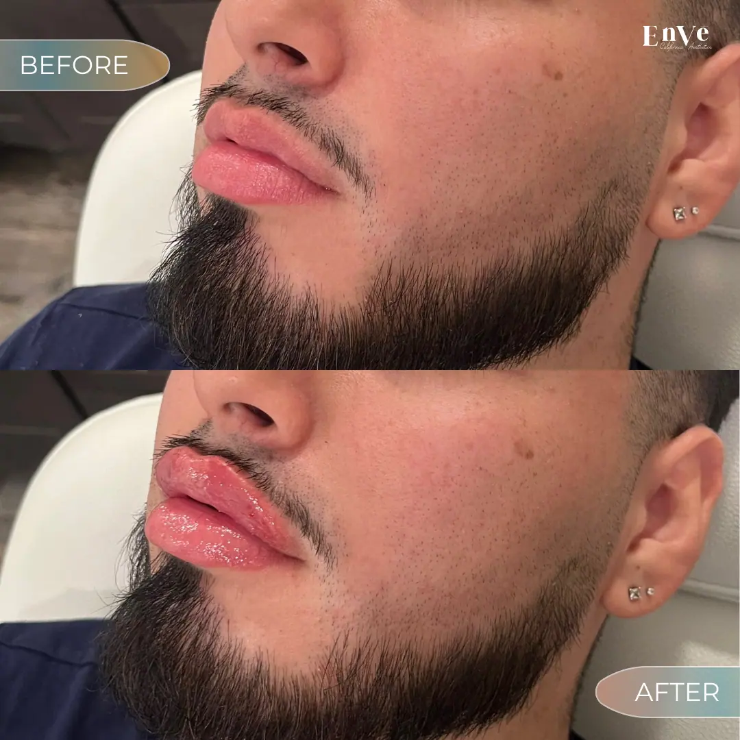 Lip Filler Before and After 17 At Enve California Aesthetics