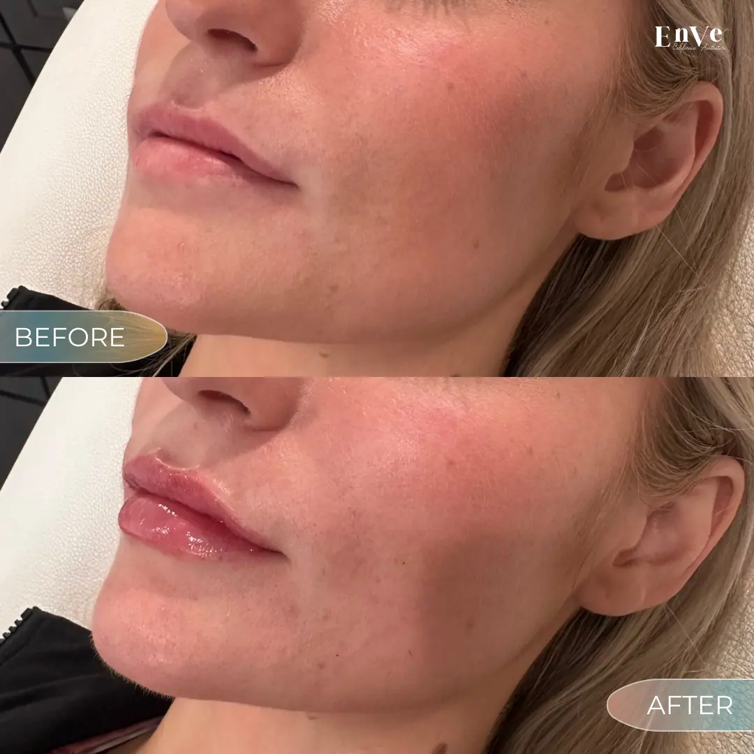 Lip Filler Before and After 8 At Enve California Aesthetics