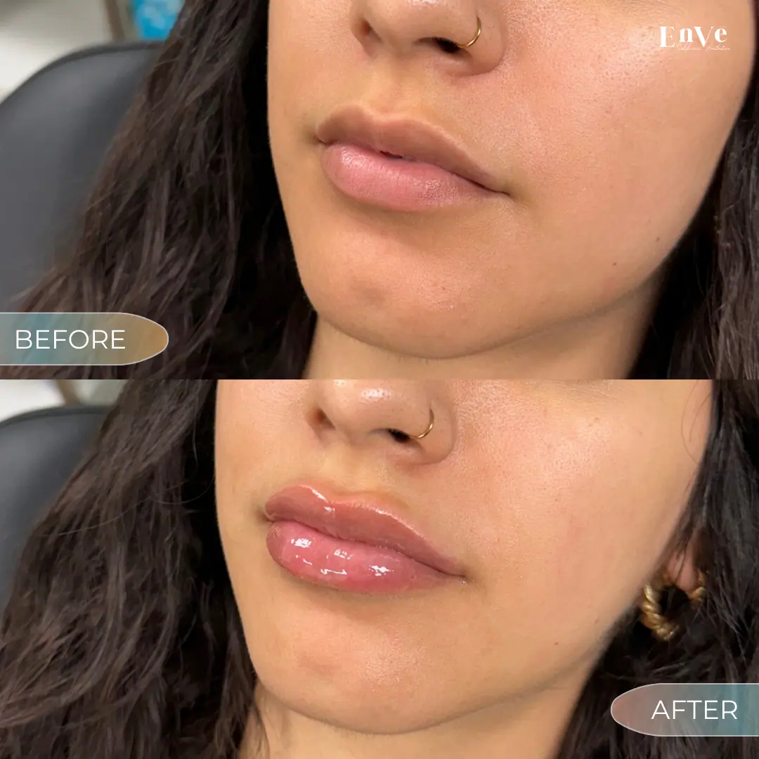 Lip Filler Before and After 10 At Enve California Aesthetics