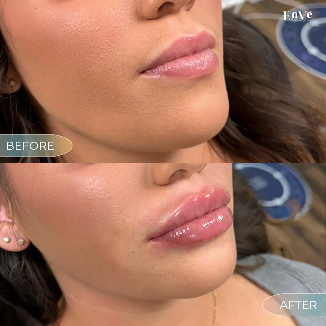 Lip Filler Before and After 11 At Enve California Aesthetics