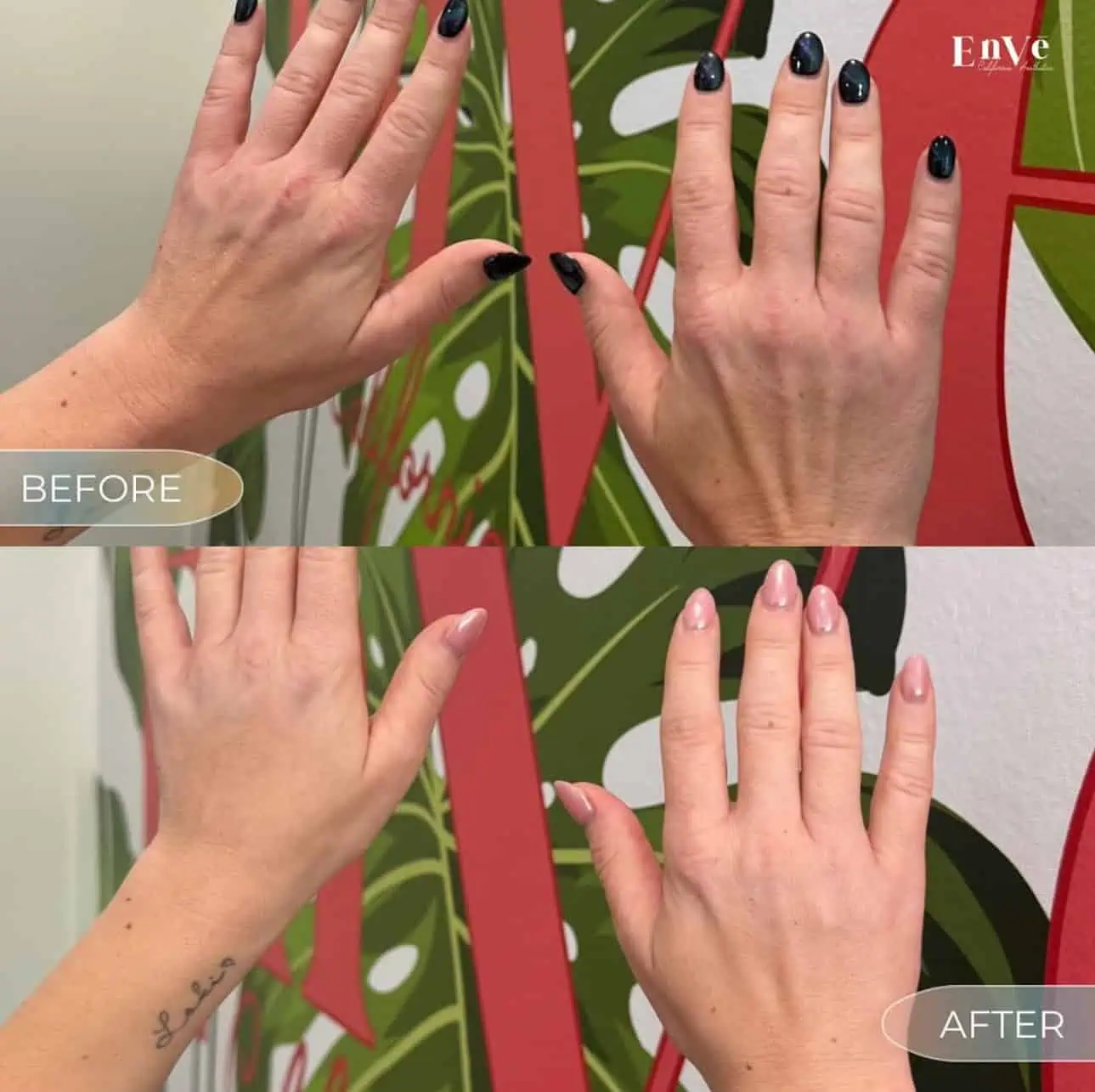 Hand Filler Before and After in Palm Springs & Orange County CA