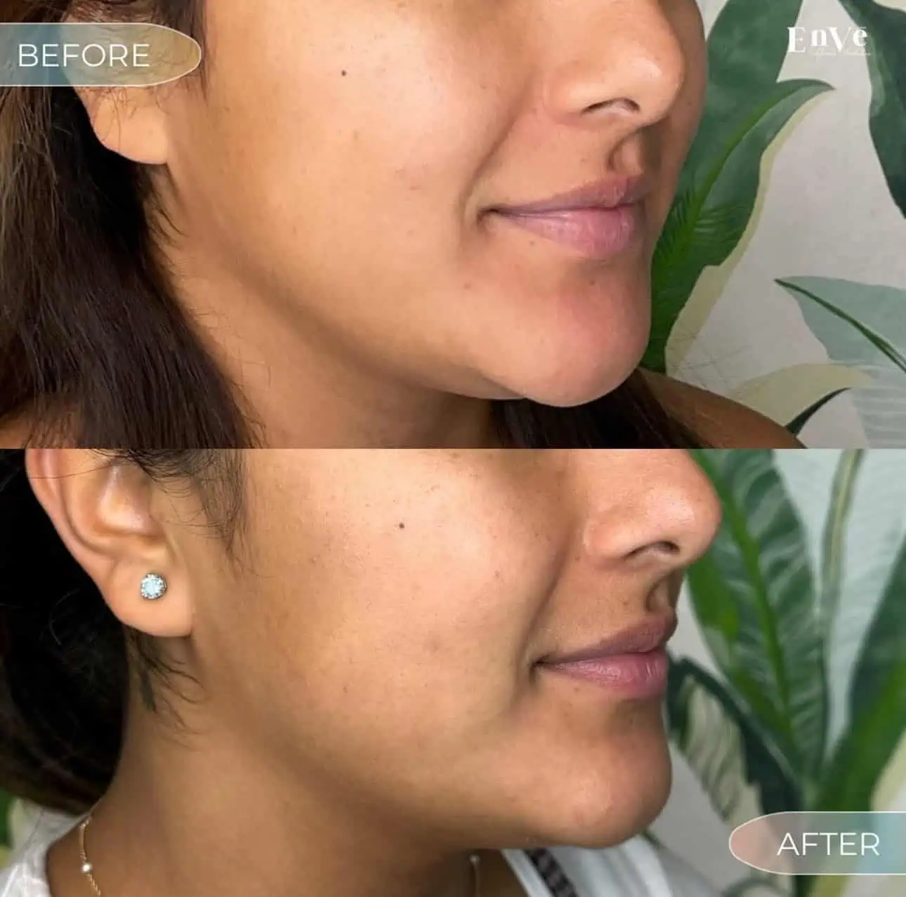 Before-and-after comparison of a patient at Enve California Aesthetics in Palm Springs, CA – demonstrating visible skin rejuvenation and smoother texture.