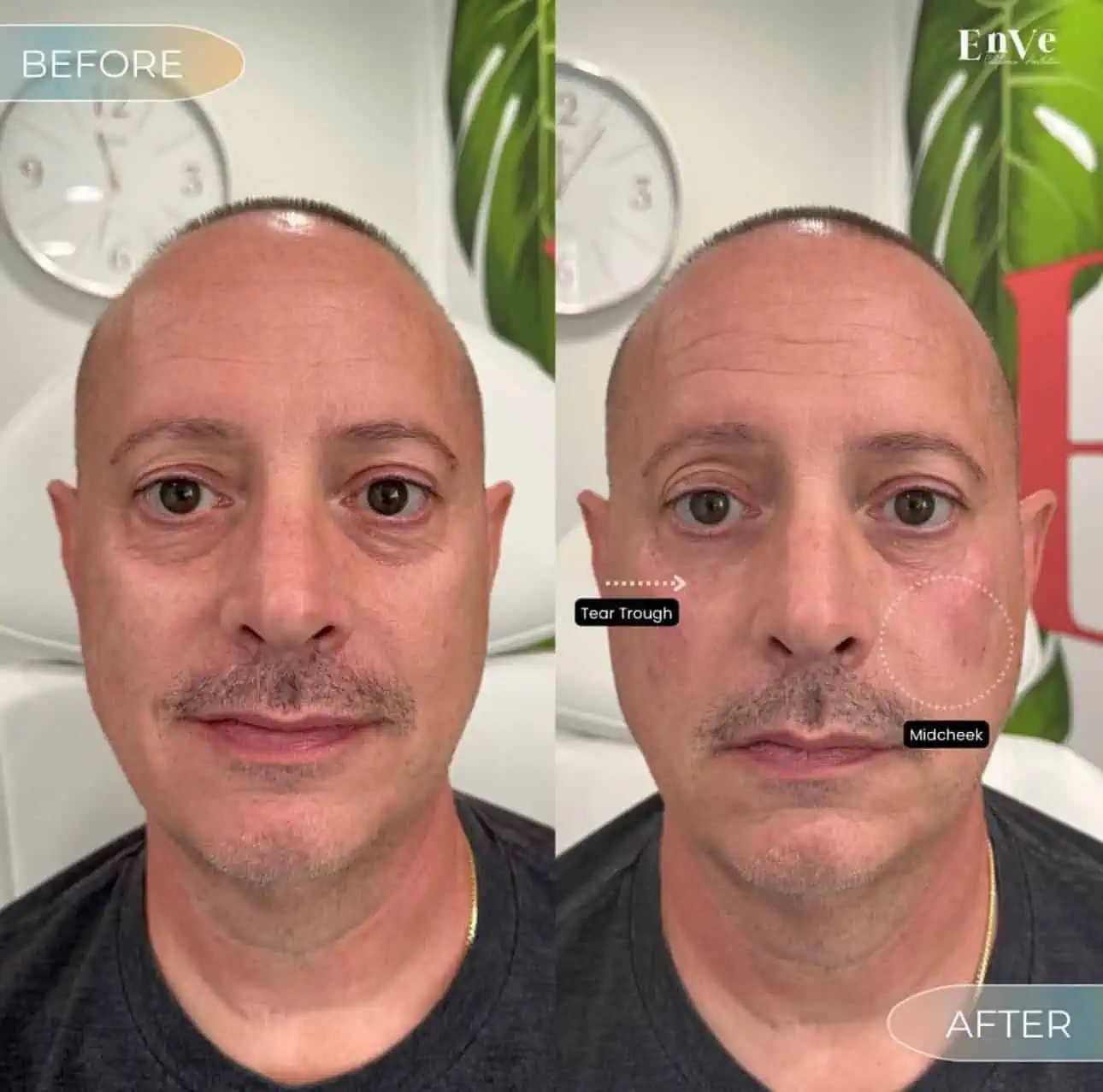 Dermal Filler Before and After10 in Palm Springs & Orange County CA