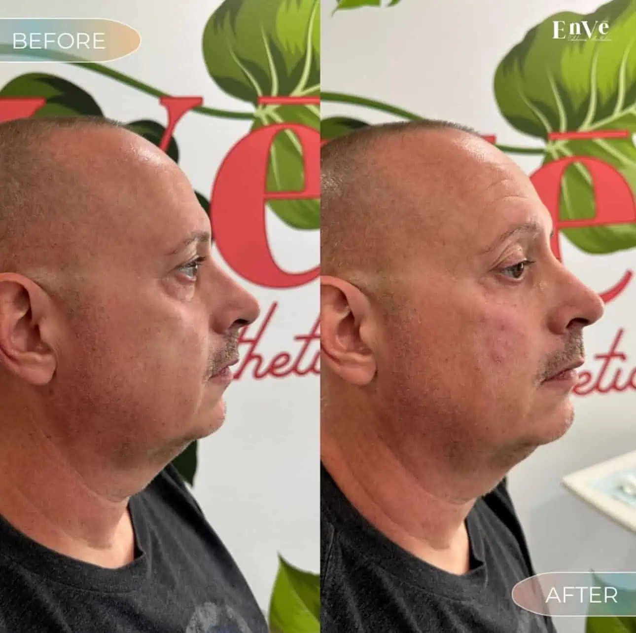 ScumSure Before and After6 in Palm Springs & Orange County CA