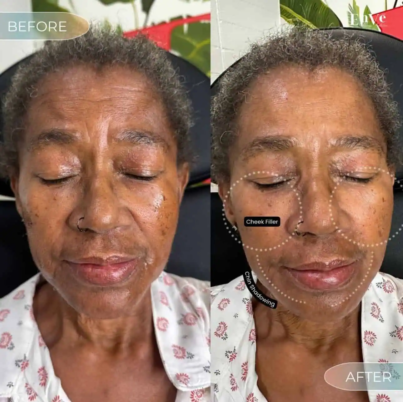 Full Face Filler Before and After 2 At Enve California Aesthetics