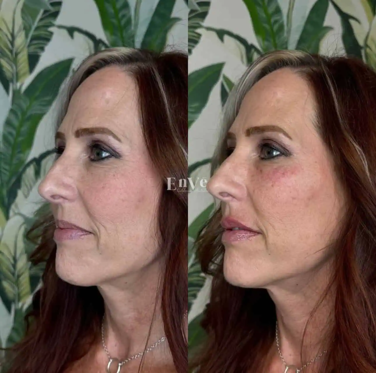 Check Filler Before and After 2 At Enve California Aesthetics