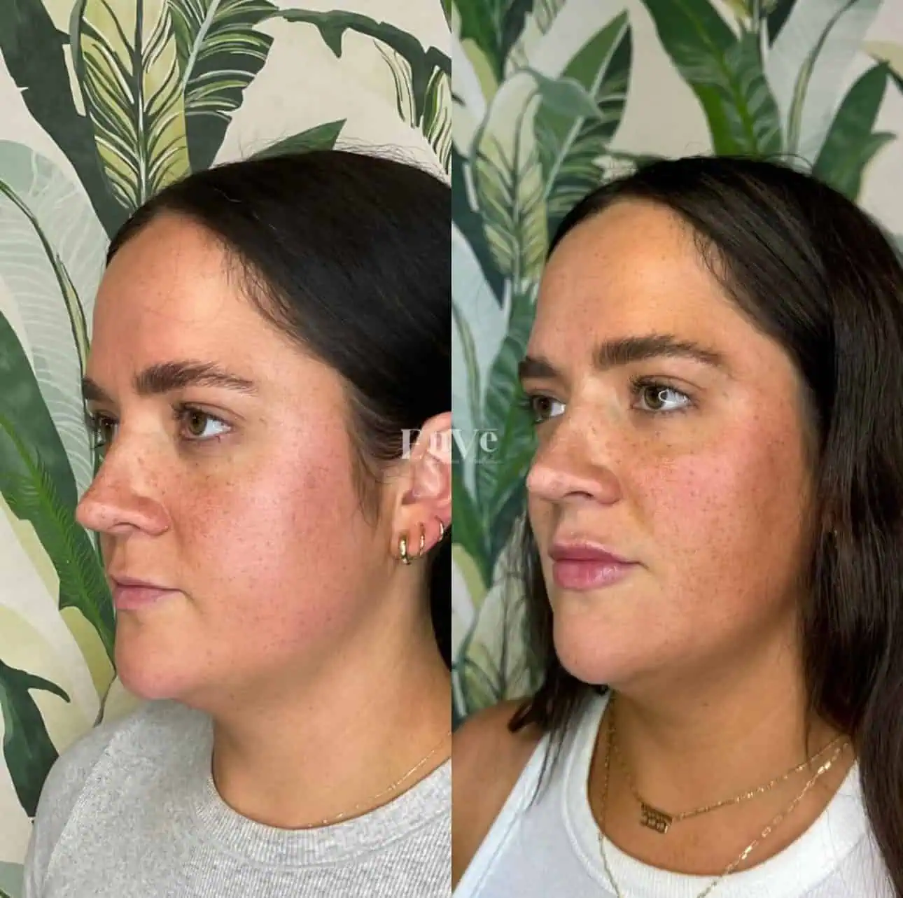 Full Face Filler Before and After3 in Palm Springs & Orange County CA