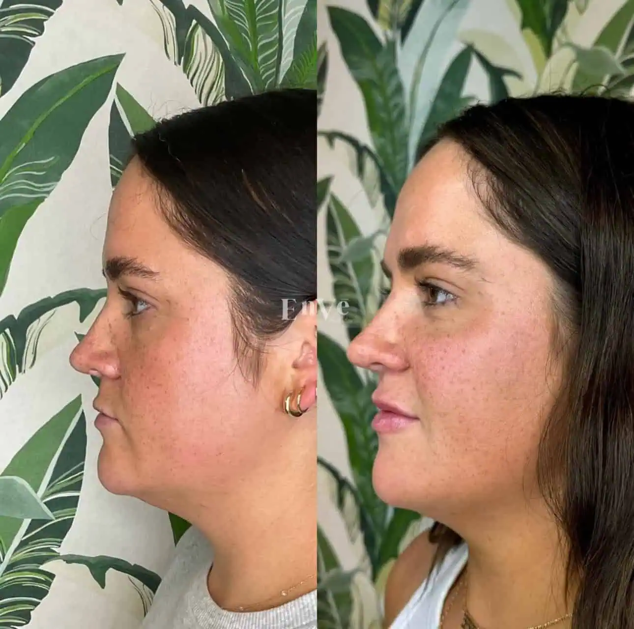 Check Filler Before and After 4 At Enve California Aesthetics