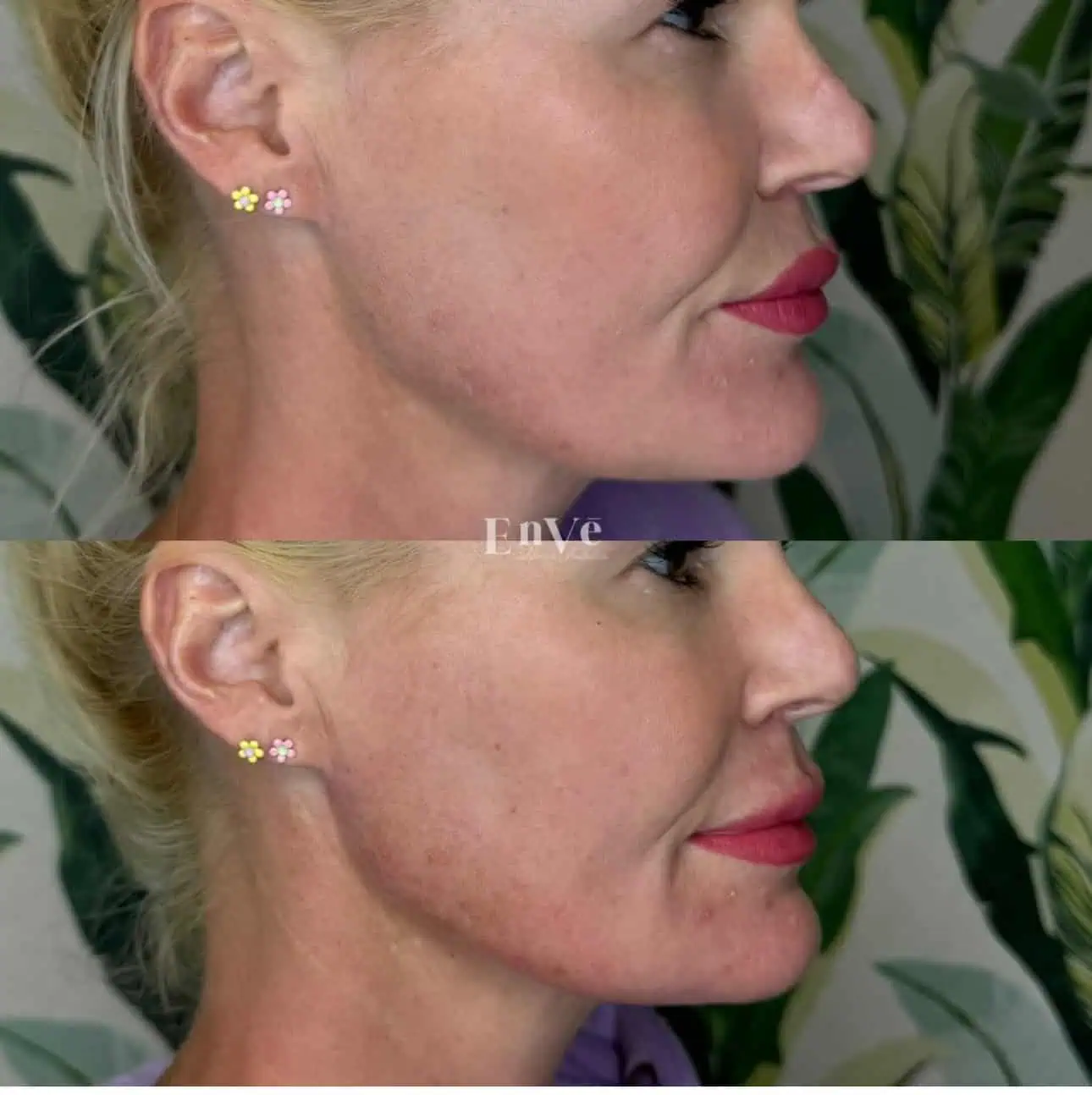 Chin Filler Before and After in Palm Springs & Orange County CA