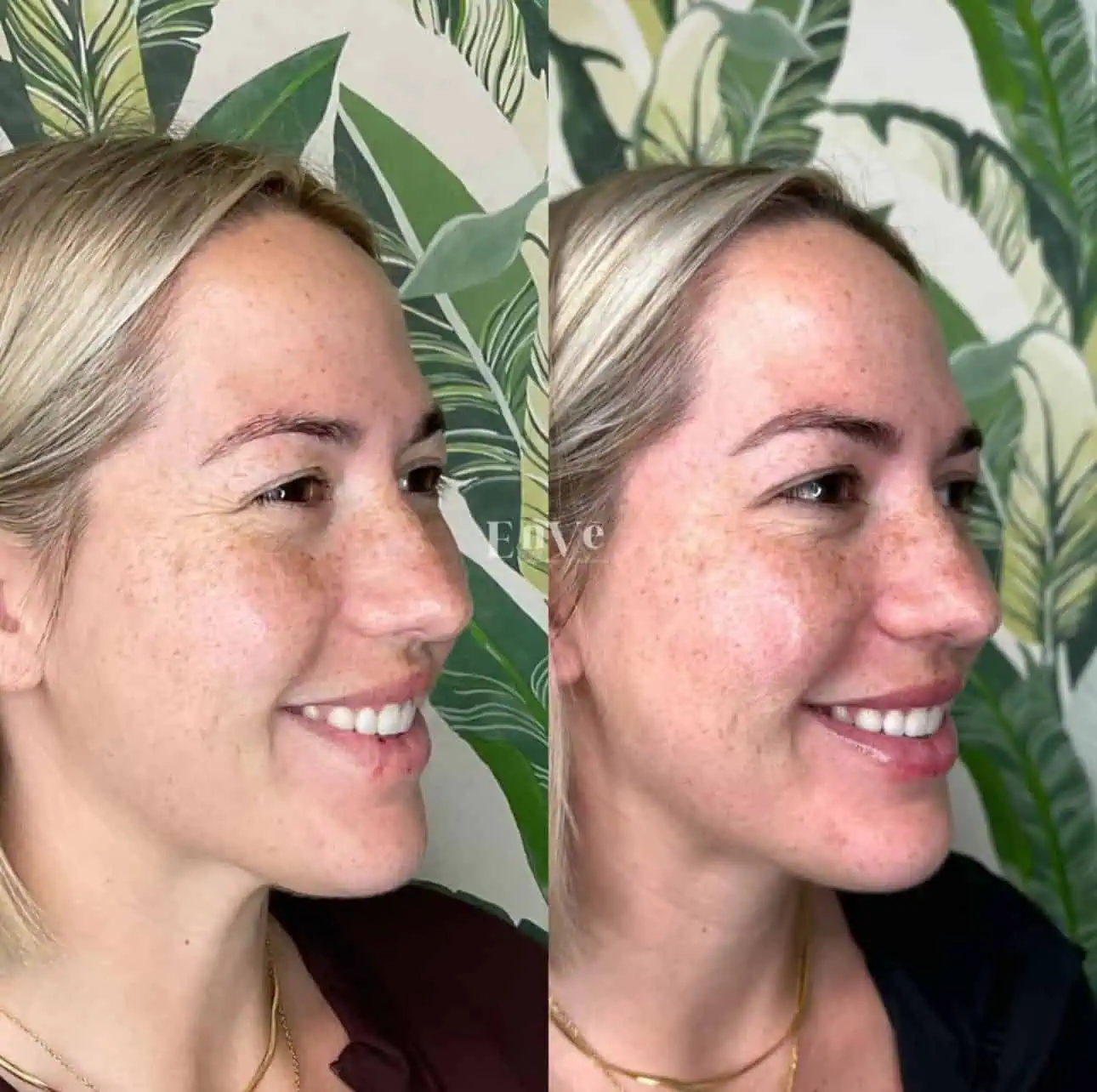 woman's face before after Botox treatment, highlighting visible forehead lines and expression wrinkles.