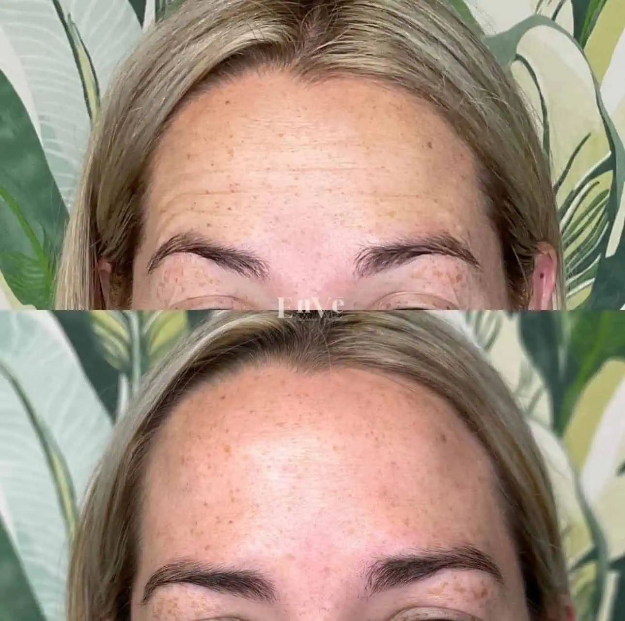 woman's face before after Botox treatment, showing smoother skin with reduced forehead lines and wrinkle-free appearance.