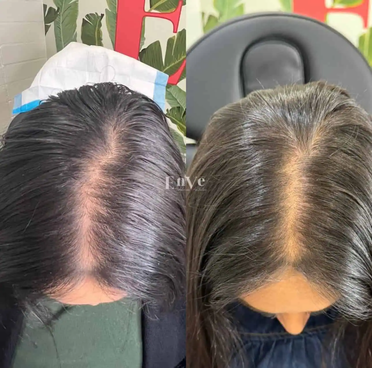 Hair Restoration Before and After in Palm Springs & Orange County CA