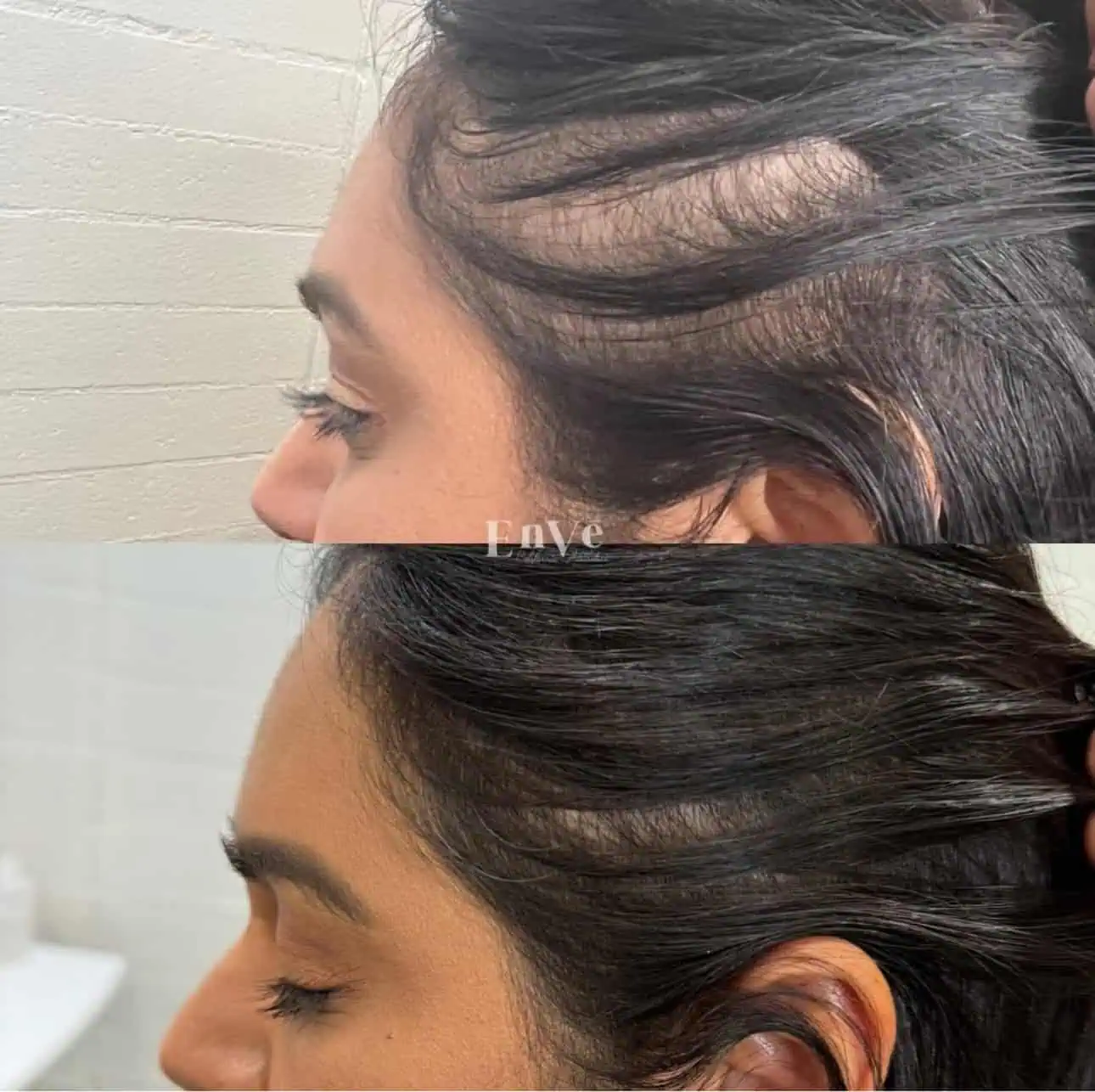 Hair Restoration Before and After in Palm Springs & Orange County CA