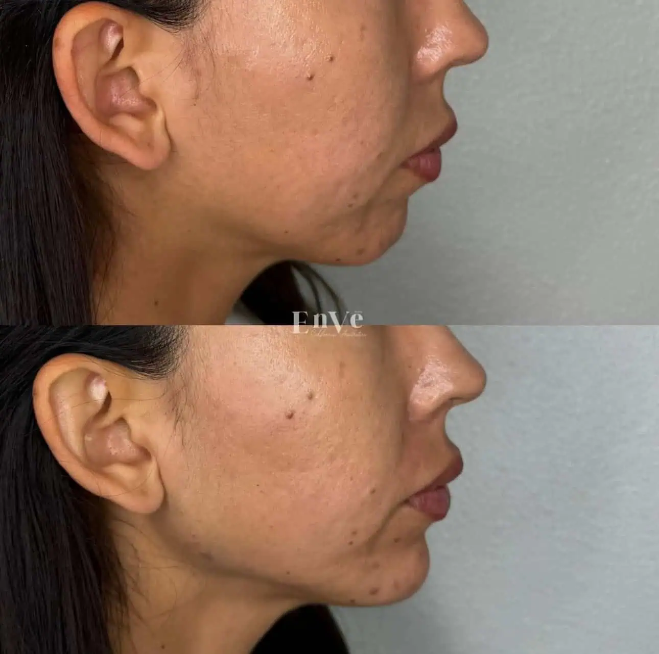 Chin Filler Before and After1 in Palm Springs & Orange County CA