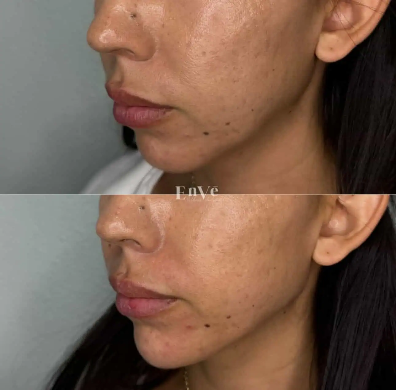 Chin Filler Before and After3 in Palm Springs & Orange County CA